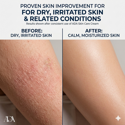ADA Skin Care Cream – Soothing Relief for Fungal Infection, Psoriasis & Eczema | Anti-Itch Formula for Healthy Skin