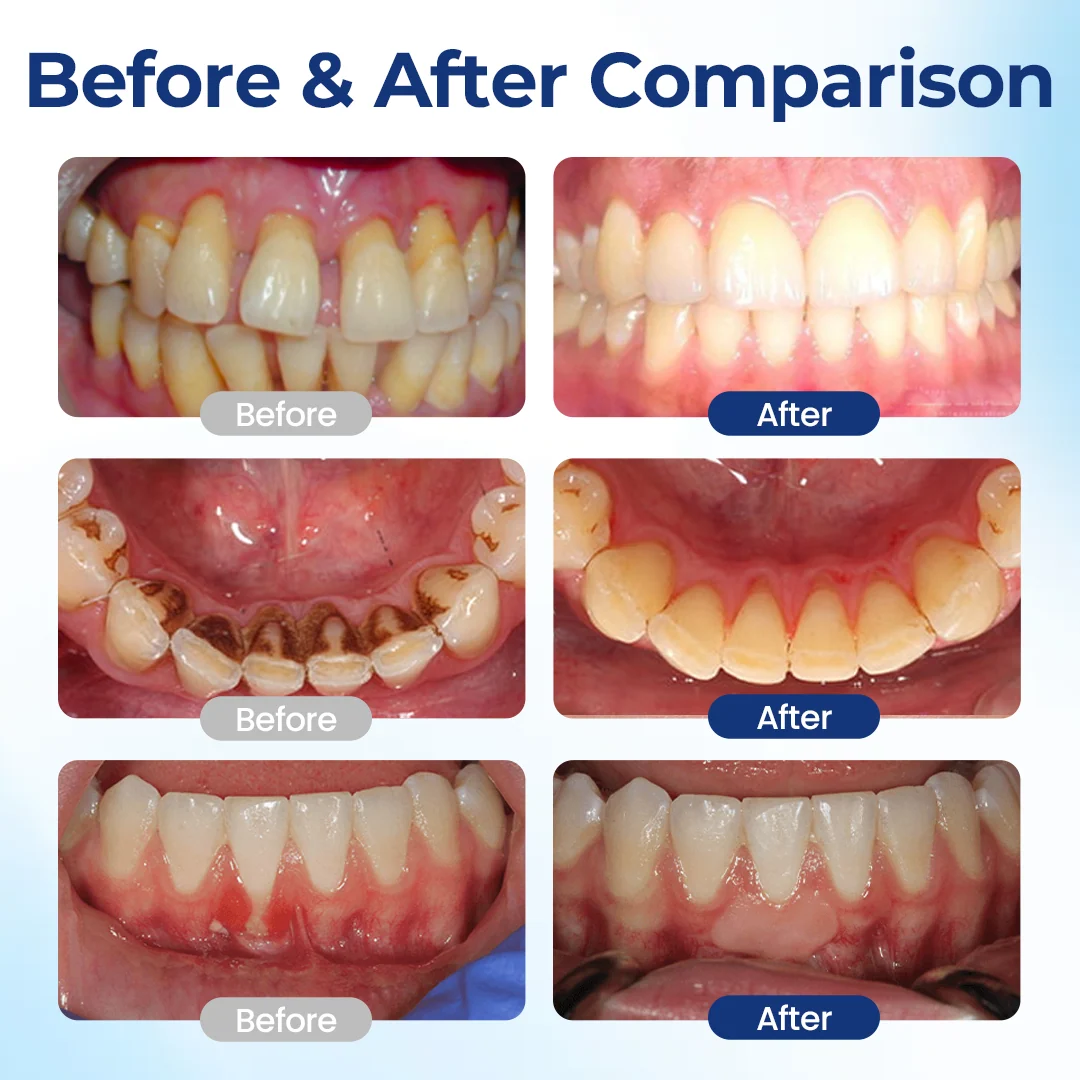 BeeTakt Oral Teeth Repair Solution