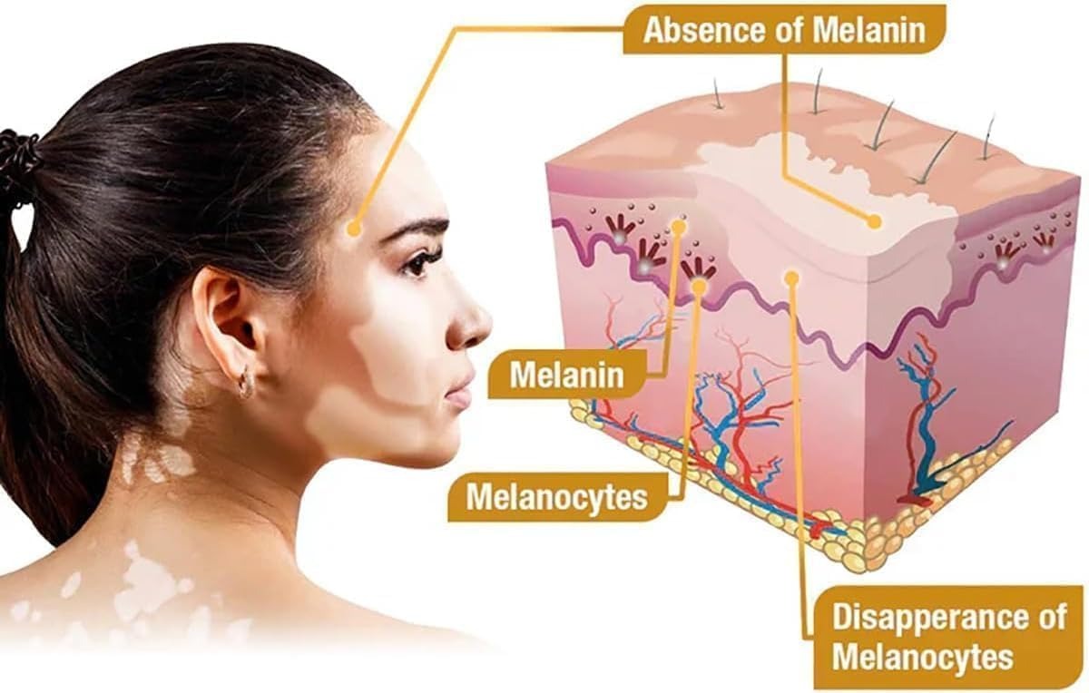 Vitiligo Bee Venom, Whitening Body Skin Care Cream
