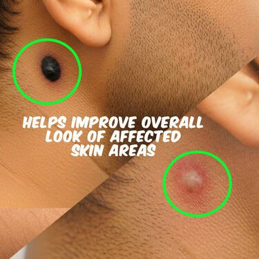 Massa Remover Gel With Free Delivery